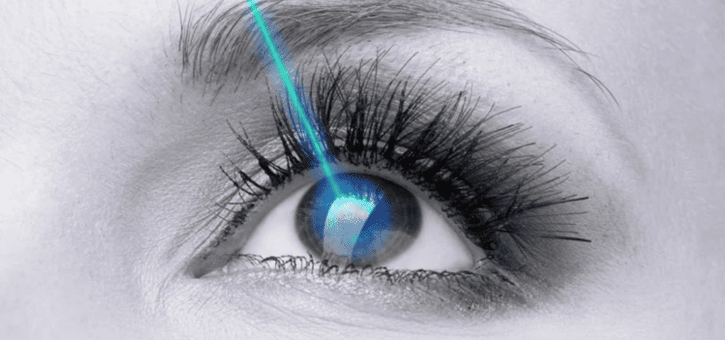 Phương pháp mổ mắt lasik